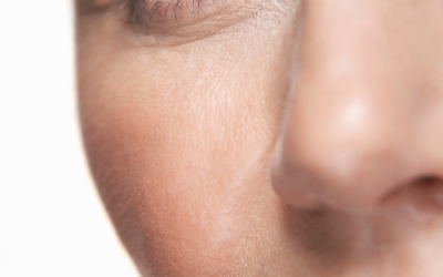 Acne and Rosacea in Menopause